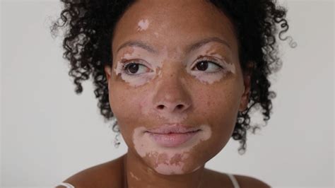 Vitiligo Update 2024 - Berget Stephie