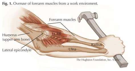 Tennis Elbow - Hughston Clinic - Hughston Health Alert