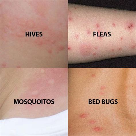 Do you think you have bed bugs? Read about the symptoms and signs, look ...