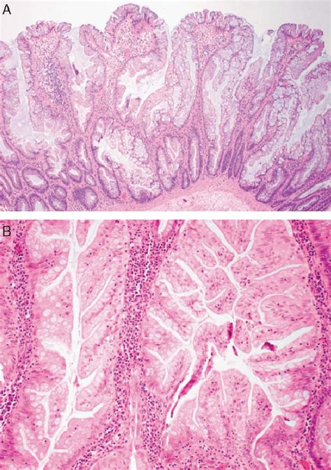 A, Sessile serrated polyp (adenoma) in case 1 with basal crypt ...