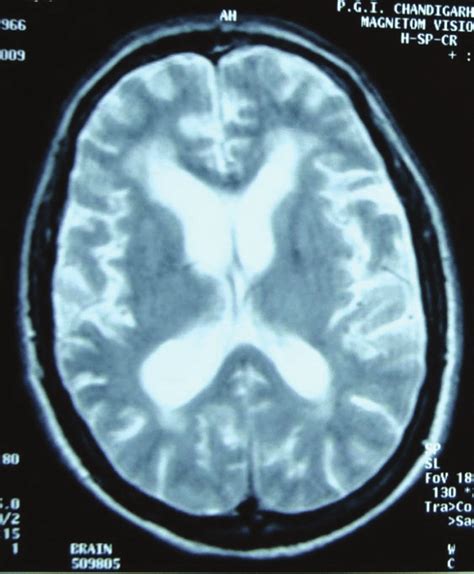 MRI Brain (Axial T2 Image) Shows Diffuse Cerebral Atrophy with Ex-vacuo ...