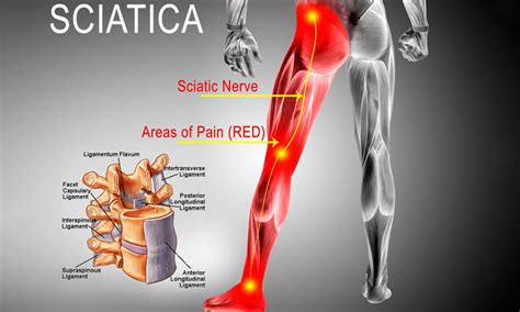 Sciatica - Travancore Ayurveda