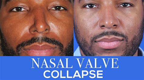 How To Fix A Collapsed Nasal Valve | Dr Moustafa Mourad | Mourad NYC ...