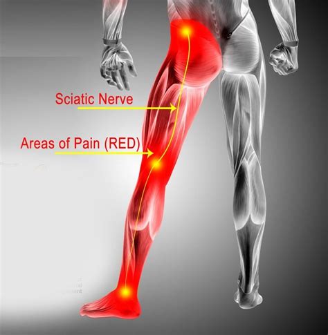 Sciatica Help 4 Friends: Say Goodbye to Sciatica Pain with These 9 ...