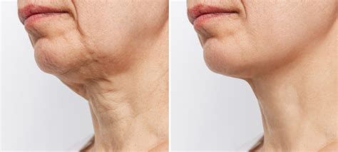 Botox For Neck Sagging Treatments and Cost