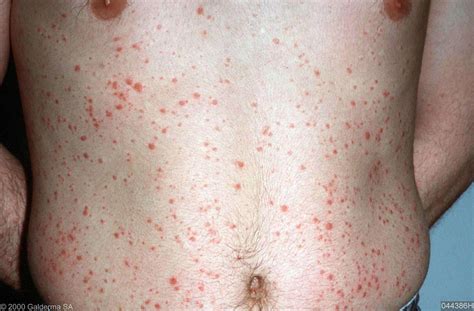 guttate psoriasis - pictures, photos