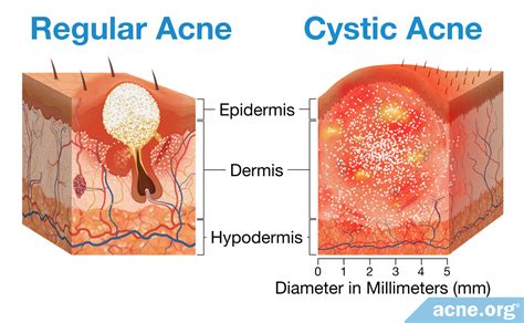 Cyst vs. Pimple: Understanding the Differences and Effective Treatments ...