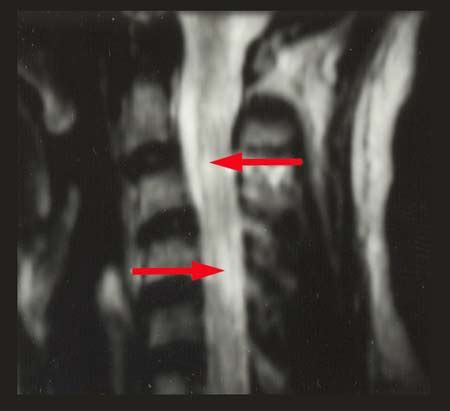 Multiple Sclerosis: Demyelination in the Cervical Spinal Cord - MRI Scan