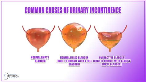 Explore the Symptom, Causes, and Treatments of Urinary Incontinence ...