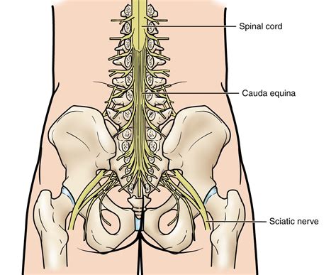 Cauda Equina Syndrome - OrthoInfo - AAOS