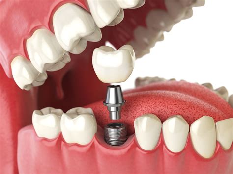 Dental Implants – Monroe, CT – John G. Fatse, DMD