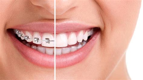 Clear Braces: All You Need to Know About Types, Costs, Benefits