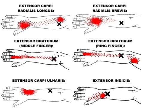 The Definitive Guide to Wrist Extensors Anatomy, Exercises & Rehab ...