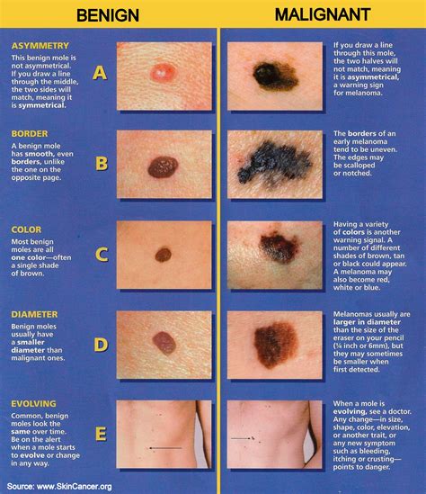 Melanoma Skin Moles