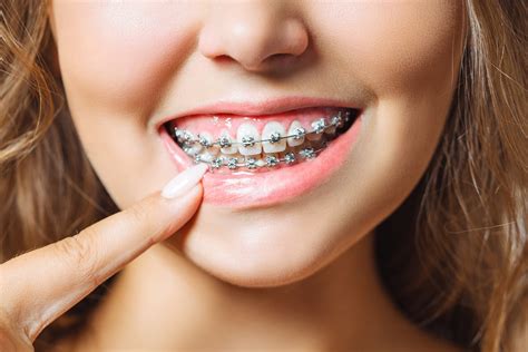 Dental Brace in Wollongong - Figtree Family Dental