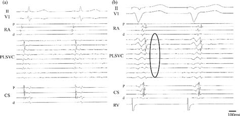 Figure 4 from The usefulness of ventricular pacing during atrial ...