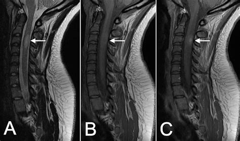 Cervical Spine Ms Lesions On Mri