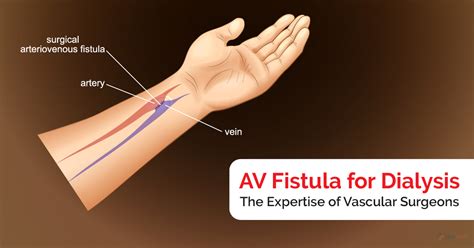 AV Fistula for Dialysis: The Expertise of Vascular Surgeons