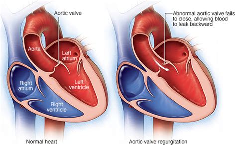 Aortic Valve Regurgitation - Causes, Symptoms, Treatment