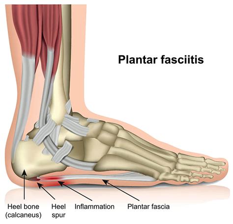 Plantar fasciitis — treatment, symptoms and causes | healthdirect