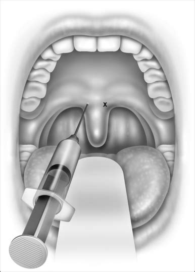 Snare uvulectomy for upper airway resistance | Pocket Dentistry