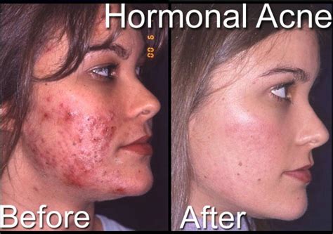 Free For Health: Severe Cystic Acne