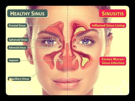 Sinus Infection | Austin Family Medicine