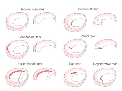 What are Medial Meniscus Tears & How to Treat Knee Injuries? - Upswing ...