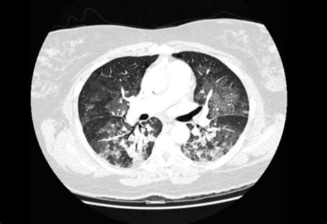 Pulmonary edema CT - wikidoc