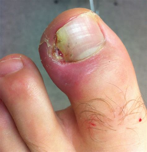 What is an Ingrown Toenail? | The Ingrown Toenail Centre