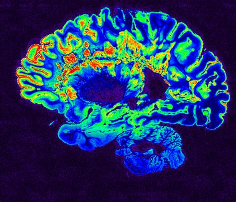 MRI Scan | This is a pseudo-colored image of high-resolution… | Flickr