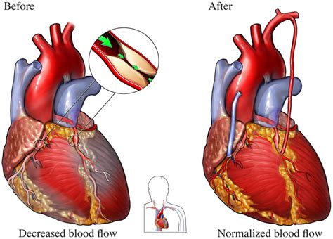 Coronary Artery Bypass Grafting - Who Needs It? | NHLBI, NIH