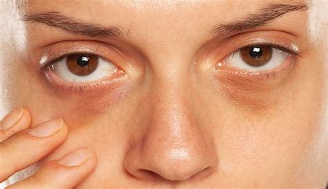 Dark Circles Under The Eyes: Causes & Treatments