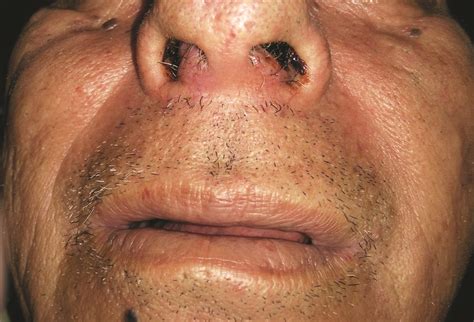 Swelling of the Nasal Septum: A Case of Nasal Septum Carcinoma