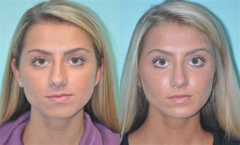 Chin & Facial Implant photos | Chevy Chase, MD | Patient 11614