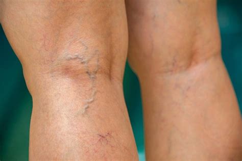 Blue Veins: What Causes Veins To Be More Visible and How to Treat Them