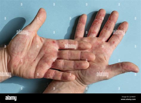 Skin rash eczema on hands hi-res stock photography and images - Alamy