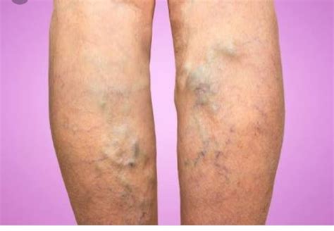 Varicose veins - Types, Symptoms, Causes & Treatment - Santripty