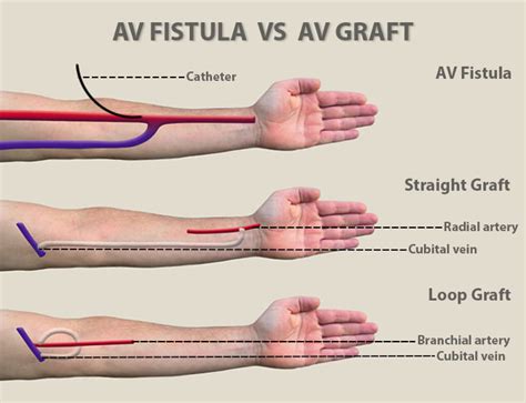 AV Fistula vs. AV Graft - Vein & Endovascular Medical Care