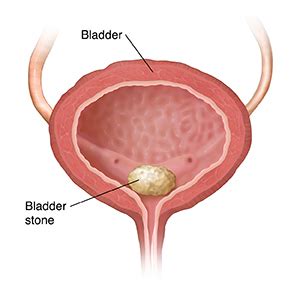 Cystolitholapaxy (Bladder Stone Surgery): Procedure & Recovery