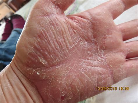 Acitretin Side Effects Psoriasis (PICTURES And REVIEW) – PSORIASIS ...