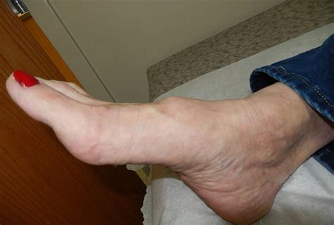 Lump On 5th Metatarsal