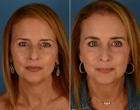 The UpLift™ Lower Face and Neck Lift Photos | Naples, FL | Patient 14192