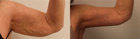 Laser Skin Tightening Before And After: In-Depth Guide - Doctor Mier