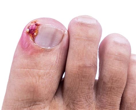 Causes And Symptoms Of An Ingrown Toenail - Ask The Nurse Expert