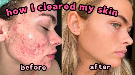 My Accutane Experience & How I Cleared My Severe Acne + Q&A (with lots ...