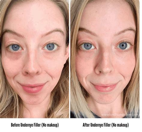 Best Filler For Under Eye Wrinkles - Property & Real Estate for Rent