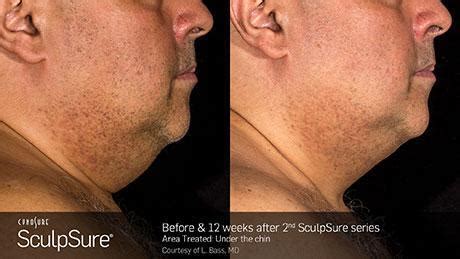 Sculpsure Before & After Gallery | Bay Area Osteopathic