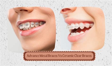 Advance Metal Braces Vs Ceramic Clear Braces