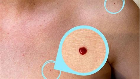 Red moles on skin: Causes and treatment options